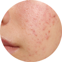Yağlı Cilt-Sebum Dengesizliği